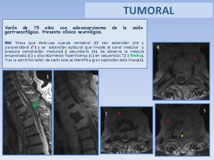 TUMORAL Varón de 75 años con adenocarcinoma gastroesofágica. Presenta clínica neurológica. de la unión