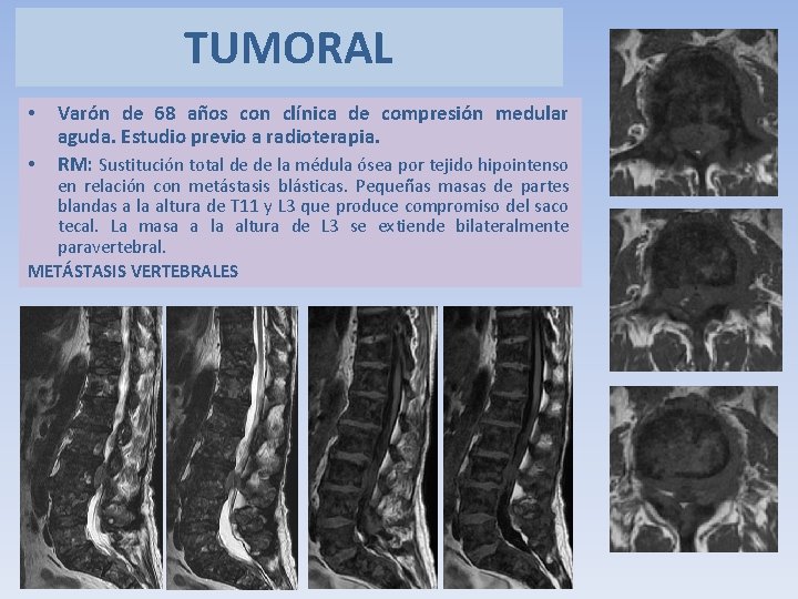 TUMORAL • • Varón de 68 años con clínica de compresión medular aguda. Estudio