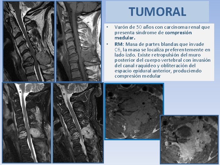 TUMORAL • • Varón de 50 años con carcinoma renal que presenta síndrome de