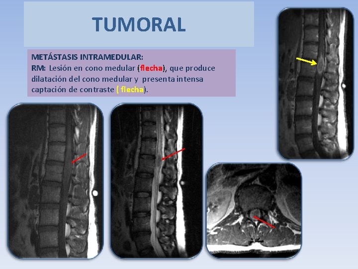 TUMORAL METÁSTASIS INTRAMEDULAR: RM: Lesión en cono medular (flecha), que produce dilatación del cono