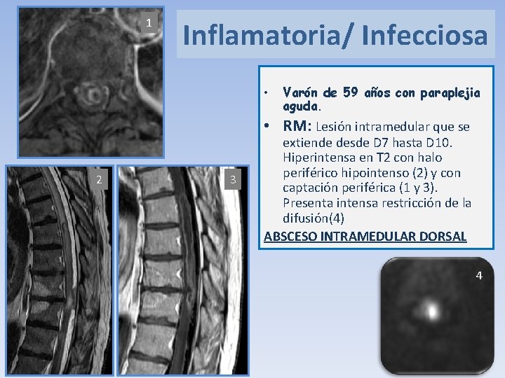 1 Inflamatoria/ Infecciosa • Varón de 59 años con paraplejia aguda. • RM: Lesión