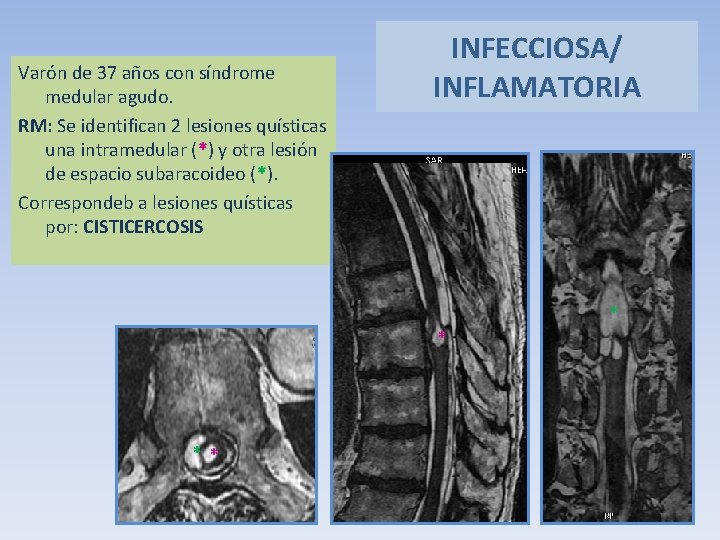 Varón de 37 años con síndrome medular agudo. RM: Se identifican 2 lesiones quísticas