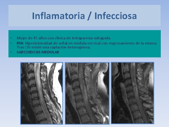 Inflamatoria / Infecciosa • • • Mujer de 45 años con clínica de tetraparesia