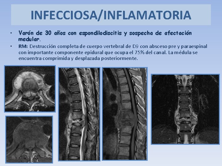 INFECCIOSA/INFLAMATORIA • • Varón de 30 años con espondilodiscitis y sospecha de afectación medular.