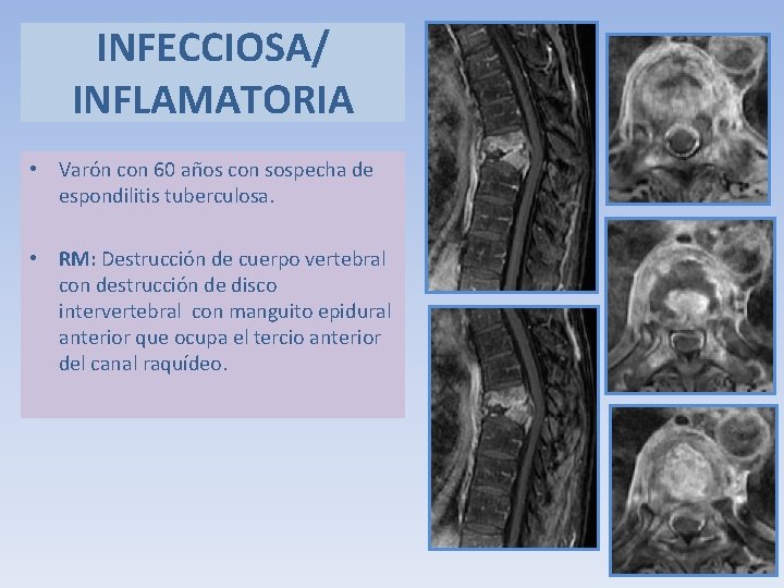 INFECCIOSA/ INFLAMATORIA • Varón con 60 años con sospecha de espondilitis tuberculosa. • RM: