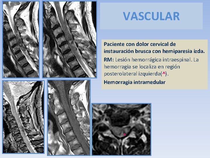 VASCULAR Paciente con dolor cervical de instauración brusca con hemiparesia izda. RM: Lesión hemorrágica