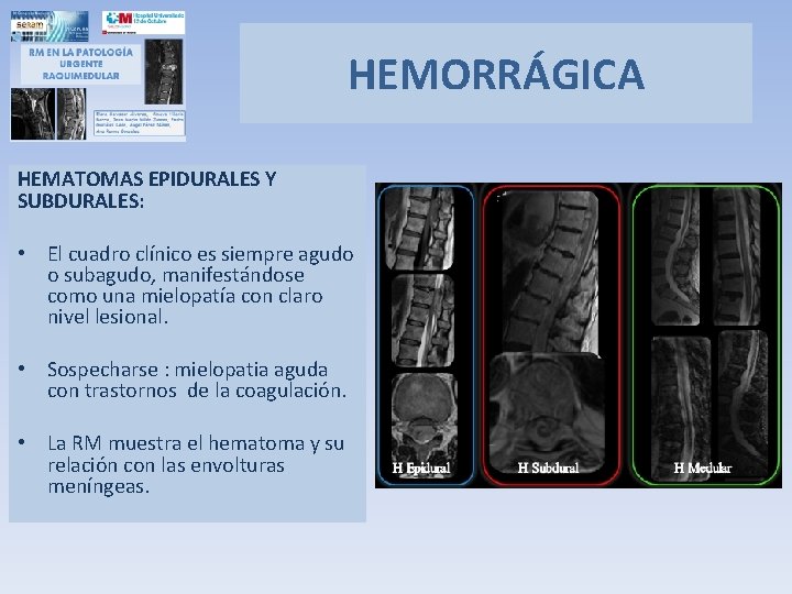 HEMORRÁGICA HEMATOMAS EPIDURALES Y SUBDURALES: • El cuadro clínico es siempre agudo o subagudo,