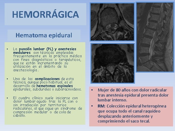 HEMORRÁGICA Hematoma epidural • La punción lumbar (PL) y anestesias medulares son técnicas empleadas