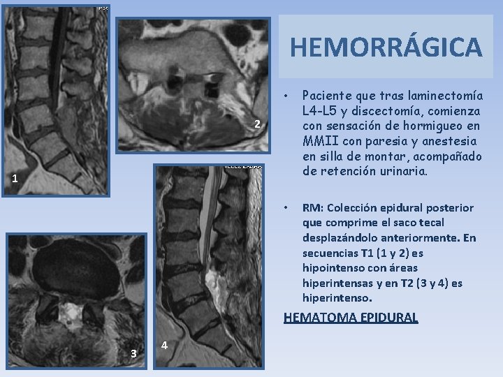 HEMORRÁGICA • Paciente que tras laminectomía L 4 -L 5 y discectomía, comienza con