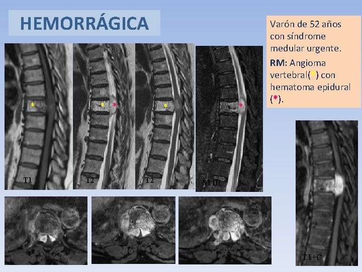 HEMORRÁGICA * T 1 * * T 2 Varón de 52 años con síndrome