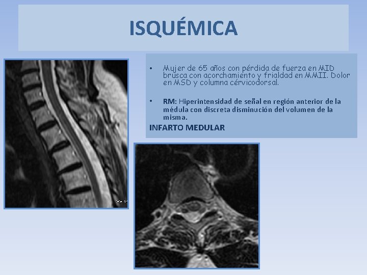 ISQUÉMICA • Mujer de 65 años con pérdida de fuerza en MID brusca con