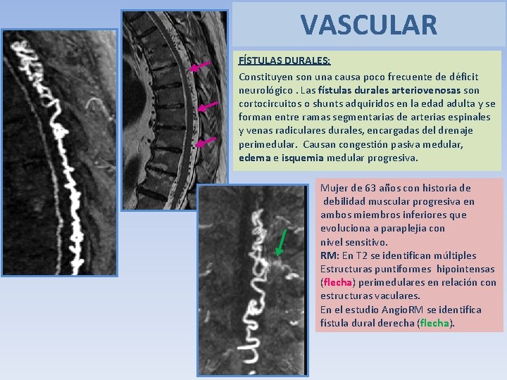 VASCULAR FÍSTULAS DURALES: Constituyen son una causa poco frecuente de déficit neurológico. Las fístulas