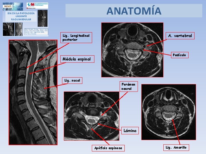 ANATOMÍA A. vertebral Lig. Longitudinal posterior Pedículo Médula espinal Lig. nucal Forámen neural Lámina