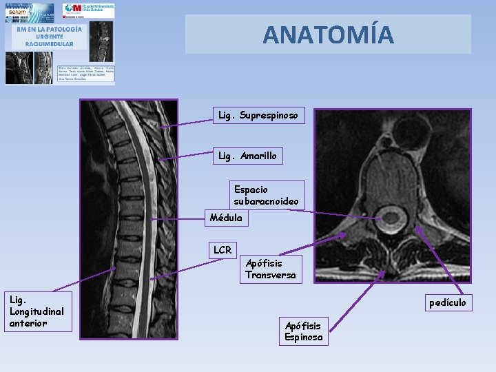 ANATOMÍA Lig. Suprespinoso Lig. Amarillo Espacio subaracnoideo Médula LCR Lig. Longitudinal anterior Apófisis Transversa