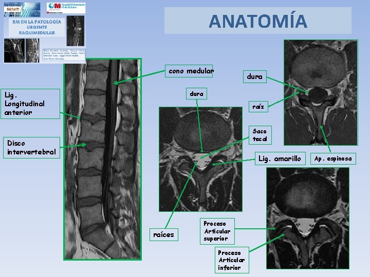 ANATOMÍA cono medular dura Lig. Longitudinal anterior raíz Saco tecal Disco intervertebral Lig. amarillo