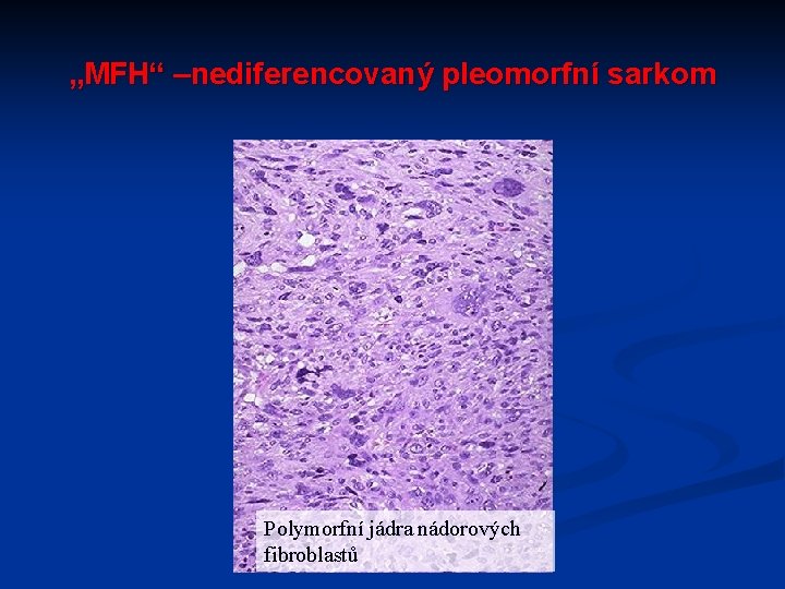 „MFH“ –nediferencovaný pleomorfní sarkom Polymorfní jádra nádorových fibroblastů 