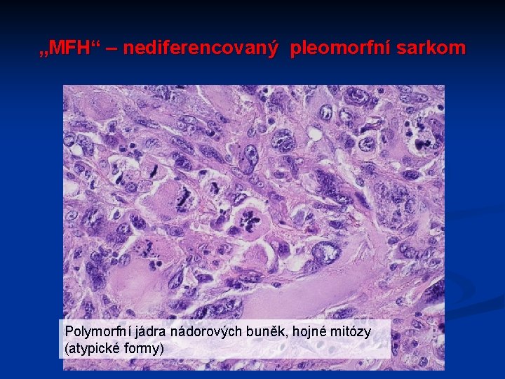 „MFH“ – nediferencovaný pleomorfní sarkom Polymorfní jádra nádorových buněk, hojné mitózy (atypické formy) 