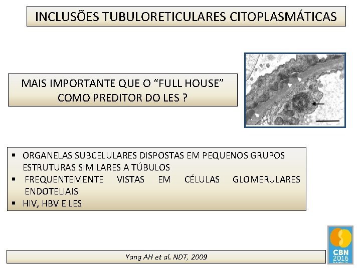 INCLUSÕES TUBULORETICULARES CITOPLASMÁTICAS MAIS IMPORTANTE QUE O “FULL HOUSE” COMO PREDITOR DO LES ?