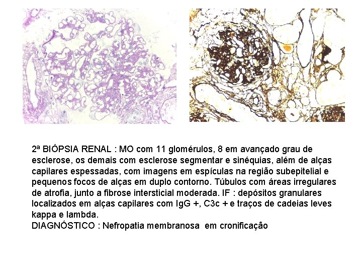 2ª BIÓPSIA RENAL : MO com 11 glomérulos, 8 em avançado grau de esclerose,