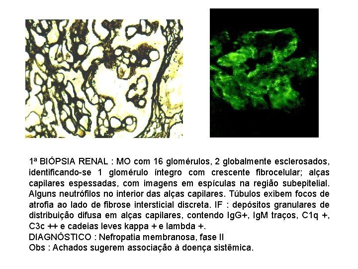 1ª BIÓPSIA RENAL : MO com 16 glomérulos, 2 globalmente esclerosados, identificando-se 1 glomérulo
