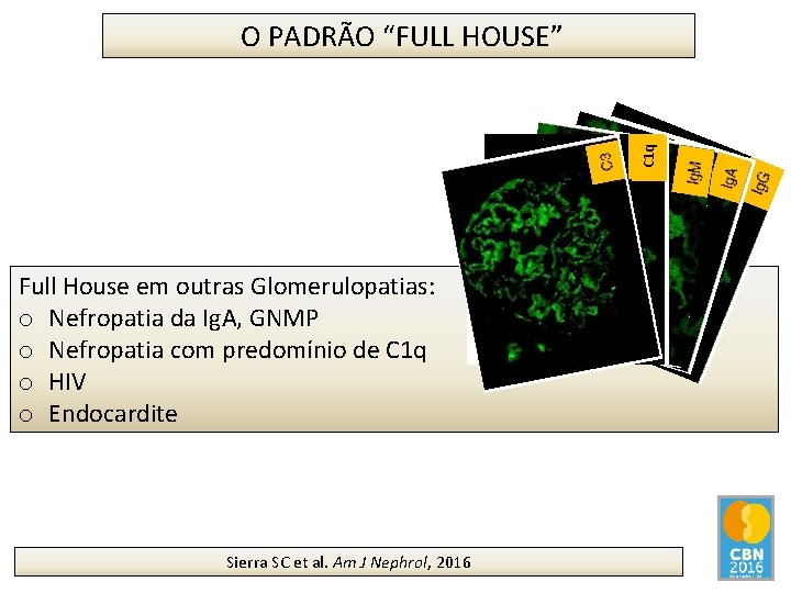 C 1 q O PADRÃO “FULL HOUSE” Full House em outras Glomerulopatias: o Nefropatia
