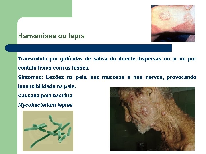 Hanseníase ou lepra Transmitida por gotículas de saliva do doente dispersas no ar ou