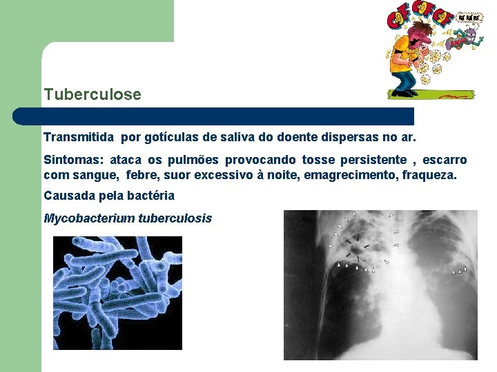 Tuberculose Transmitida por gotículas de saliva do doente dispersas no ar. Sintomas: ataca os