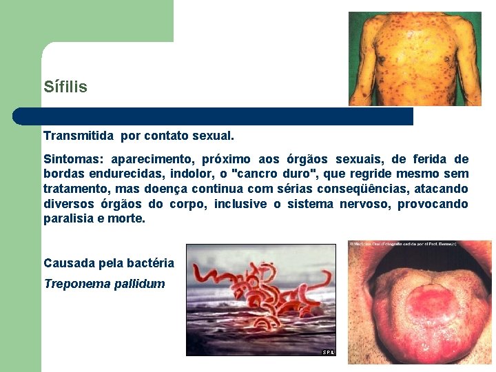 Sífilis Transmitida por contato sexual. Sintomas: aparecimento, próximo aos órgãos sexuais, de ferida de