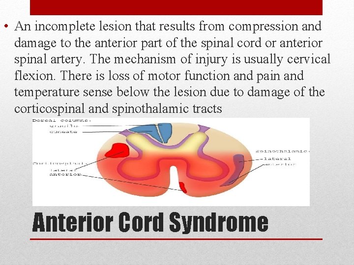 • An incomplete lesion that results from compression and damage to the anterior • An incomplete lesion that results from compression and damage to the anterior