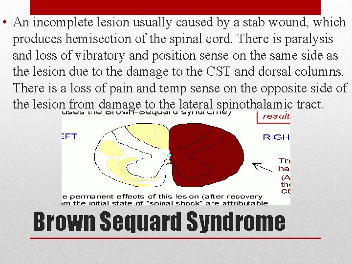 • An incomplete lesion usually caused by a stab wound, which produces hemisection • An incomplete lesion usually caused by a stab wound, which produces hemisection