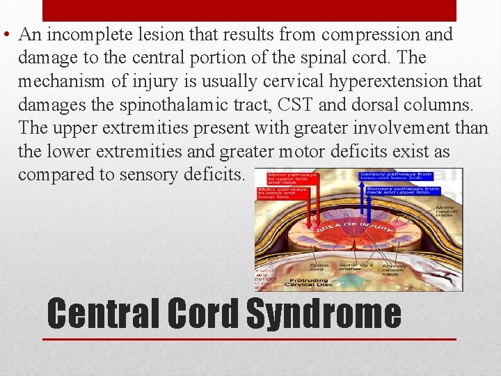 • An incomplete lesion that results from compression and damage to the central • An incomplete lesion that results from compression and damage to the central