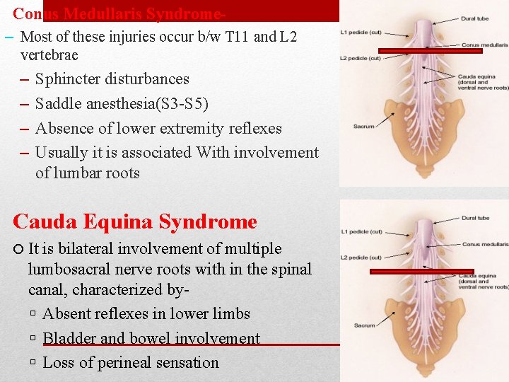 Conus Medullaris Syndrome– Most of these injuries occur b/w T 11 and L 2 Conus Medullaris Syndrome– Most of these injuries occur b/w T 11 and L 2