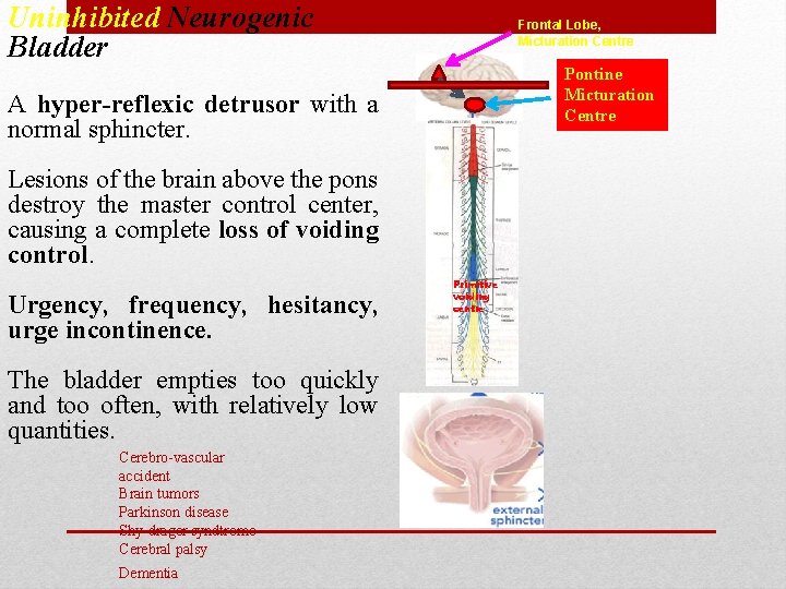 Uninhibited Neurogenic Bladder Frontal Lobe, Micturation Centre Pontine Micturation Centre A hyper-reflexic detrusor with Uninhibited Neurogenic Bladder Frontal Lobe, Micturation Centre Pontine Micturation Centre A hyper-reflexic detrusor with
