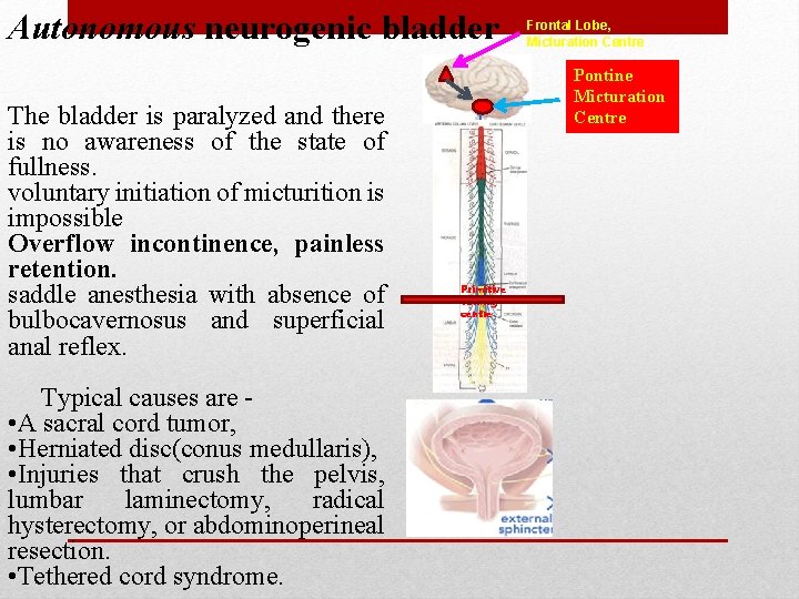 Autonomous neurogenic bladder The bladder is paralyzed and there is no awareness of the Autonomous neurogenic bladder The bladder is paralyzed and there is no awareness of the