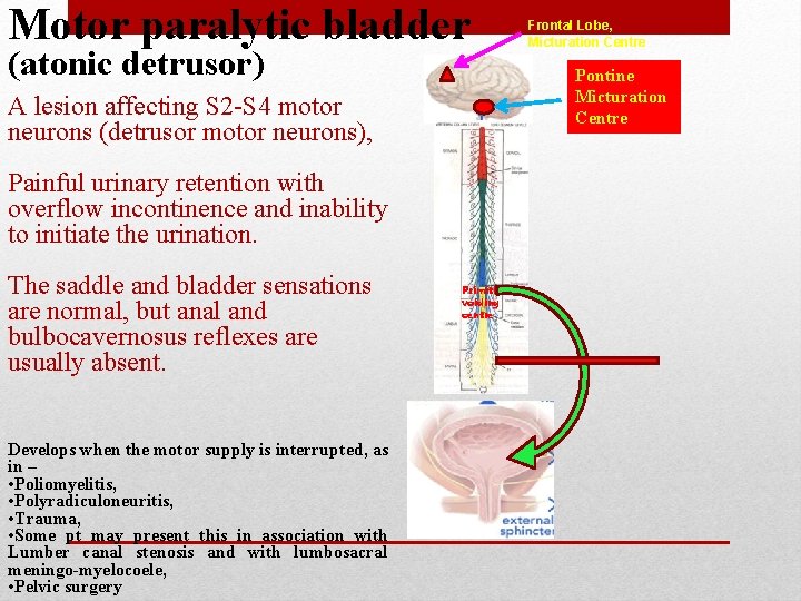 Motor paralytic bladder (atonic detrusor) Pontine Micturation Centre A lesion affecting S 2 -S Motor paralytic bladder (atonic detrusor) Pontine Micturation Centre A lesion affecting S 2 -S