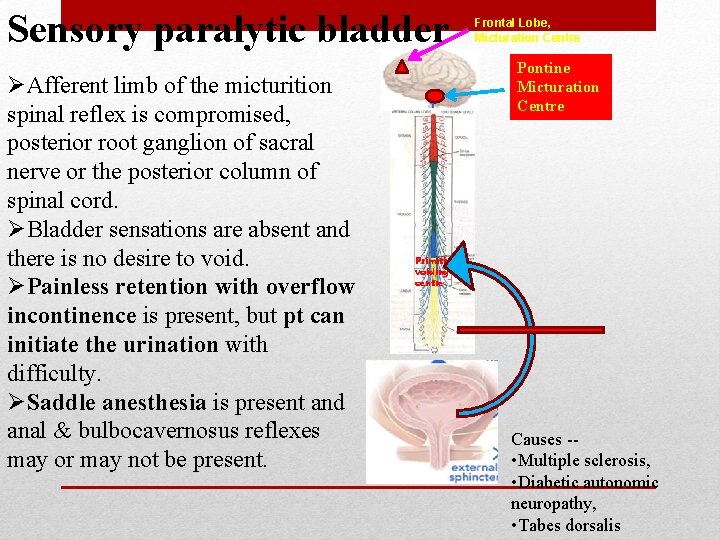 Sensory paralytic bladder ØAfferent limb of the micturition spinal reflex is compromised, posterior root Sensory paralytic bladder ØAfferent limb of the micturition spinal reflex is compromised, posterior root