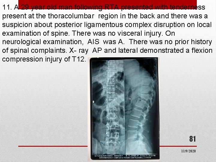 11. A 29 year old man following RTA presented with tenderness present at the 11. A 29 year old man following RTA presented with tenderness present at the