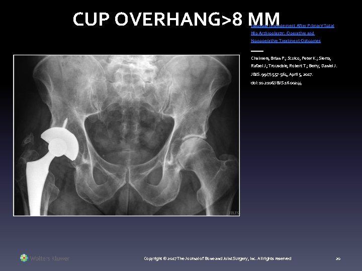 CUP OVERHANG>8 MM Iliopsoas Impingement After Primary Total Hip Arthroplasty: Operative and Nonoperative Treatment