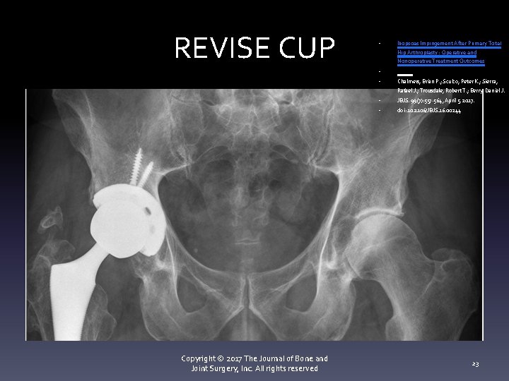 REVISE CUP Copyright © 2017 The Journal of Bone and Joint Surgery, Inc. All REVISE CUP Copyright © 2017 The Journal of Bone and Joint Surgery, Inc. All