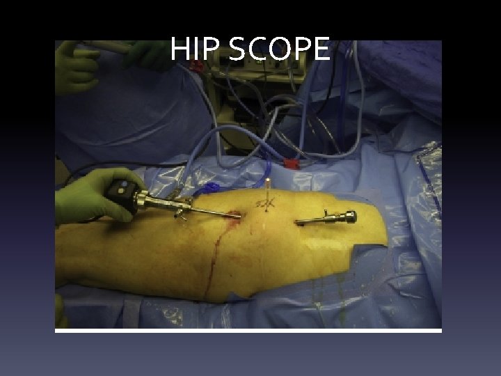HIP SCOPE HIP SCOPE