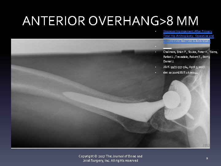 ANTERIOR OVERHANG>8 MM • Iliopsoas Impingement After Primary Total Hip Arthroplasty: Operative and Nonoperative ANTERIOR OVERHANG>8 MM • Iliopsoas Impingement After Primary Total Hip Arthroplasty: Operative and Nonoperative