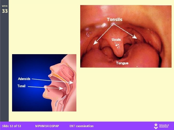 WEEK 33 Slide 12 of 53 MPHM 14 OSPAP ENT examination 