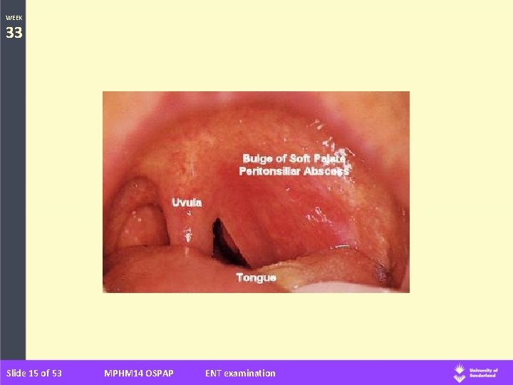 WEEK 33 Slide 15 of 53 MPHM 14 OSPAP ENT examination 