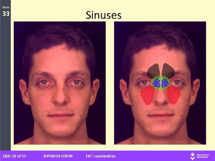 WEEK Sinuses 33 Slide 19 of 53 MPHM 14 OSPAP ENT examination 