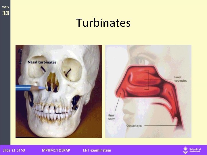 WEEK 33 Slide 21 of 53 Turbinates MPHM 14 OSPAP ENT examination 