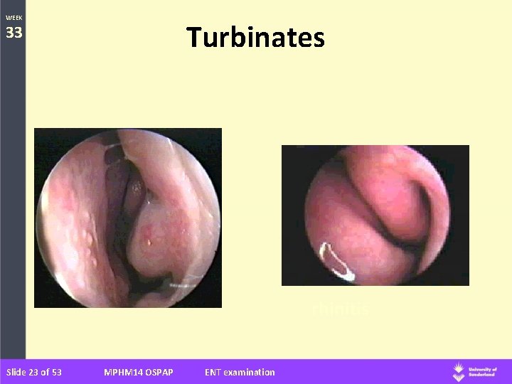 WEEK Turbinates 33 rhinitis Slide 23 of 53 MPHM 14 OSPAP ENT examination 