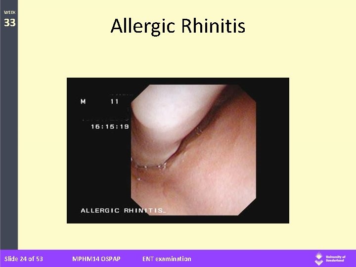 WEEK 33 Slide 24 of 53 Allergic Rhinitis MPHM 14 OSPAP ENT examination 