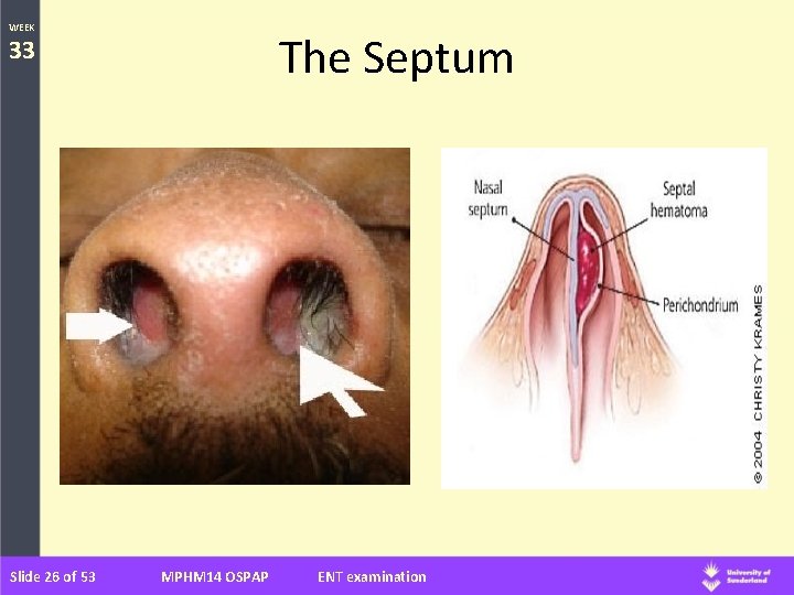 WEEK The Septum 33 Slide 26 of 53 MPHM 14 OSPAP ENT examination 