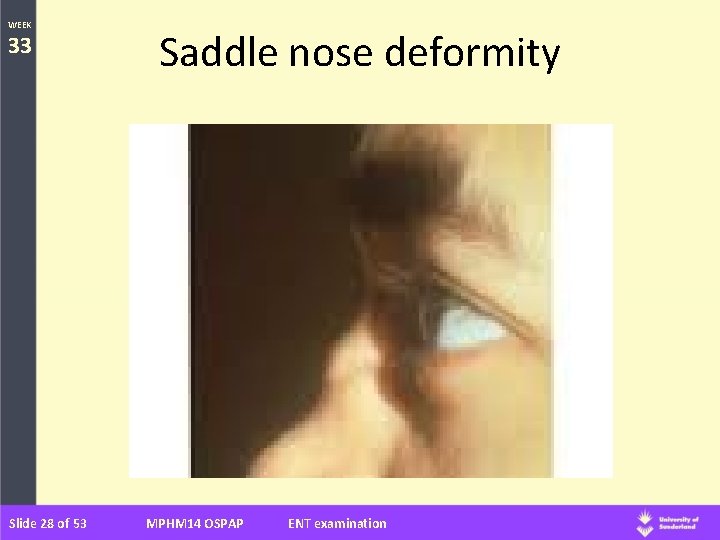 WEEK 33 Slide 28 of 53 Saddle nose deformity MPHM 14 OSPAP ENT examination