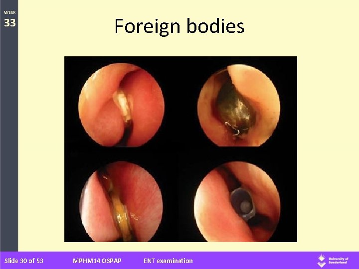 WEEK 33 Slide 30 of 53 Foreign bodies MPHM 14 OSPAP ENT examination 